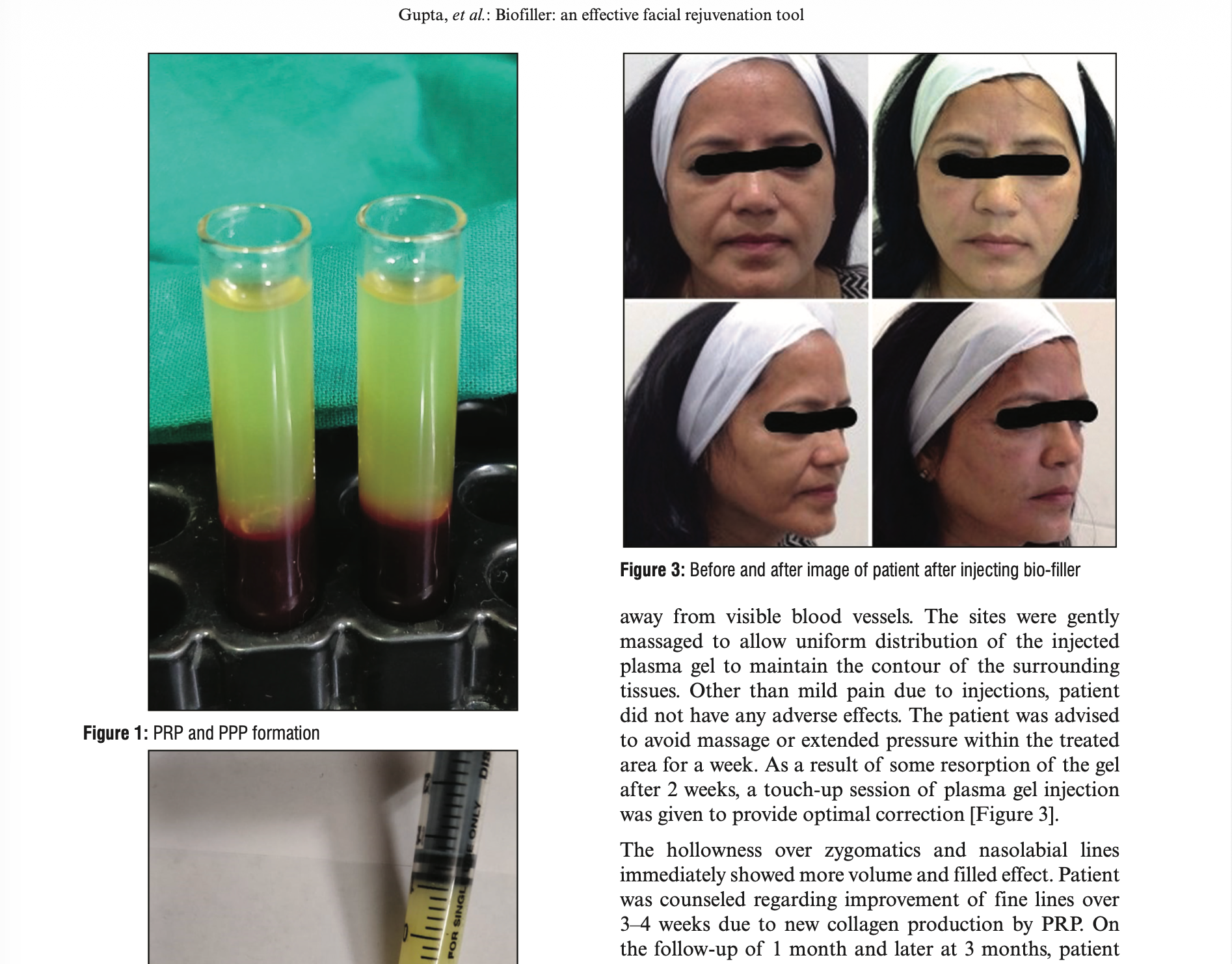 Bio-Filler: An Effective Facial Rejuvenation Tool—Easy on Pocket