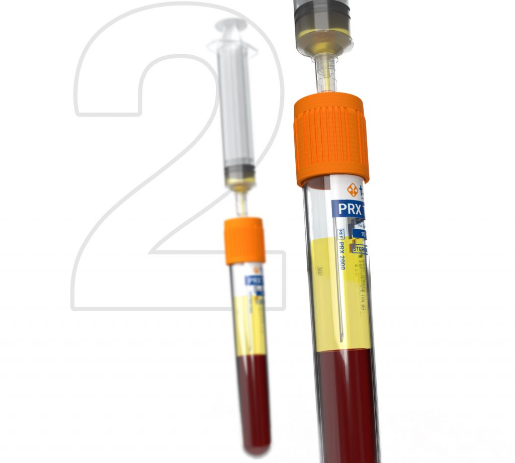 T-Lab™ PRX Tubes (PRF/Platelet-Rich Fibrin Tubes) – T-Lab™ Australia ...